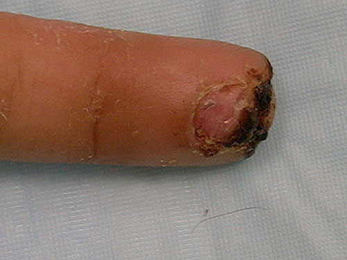 Finger fresh from the wound